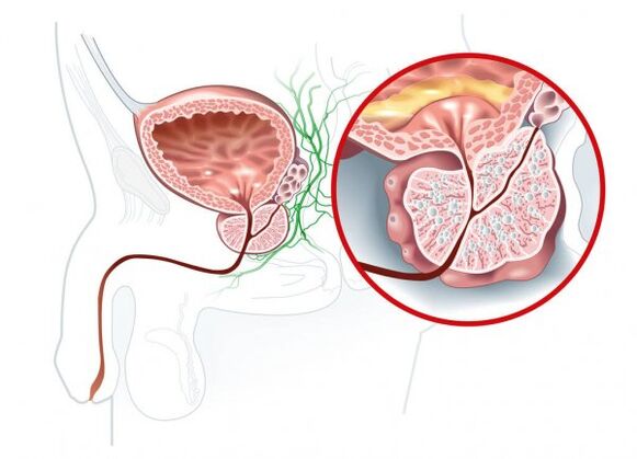 Mga sintomas ng prostatitis