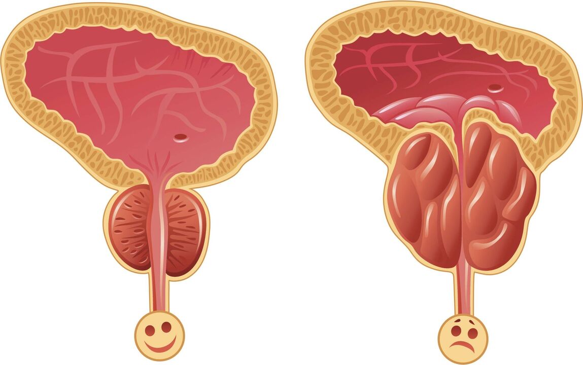 mga dahilan para sa pag-unlad ng prostatitis