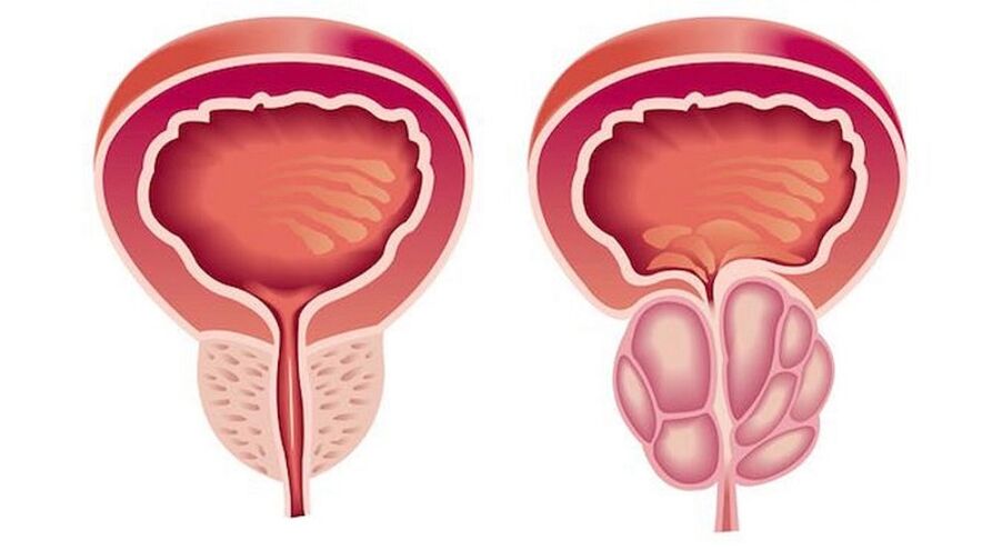 Malusog at namumula na prostate na may prostatitis