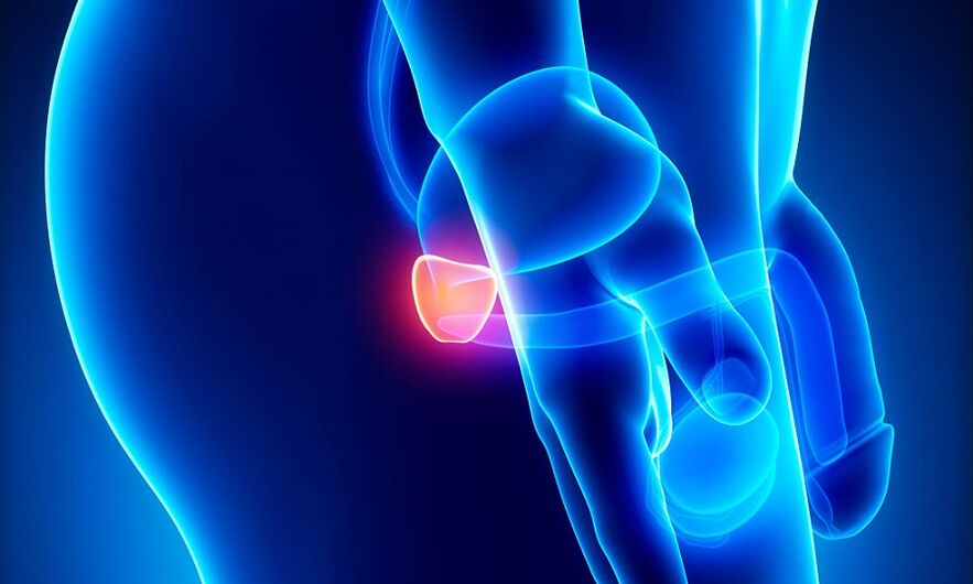 Pamamaga ng prosteyt na may prostatitis