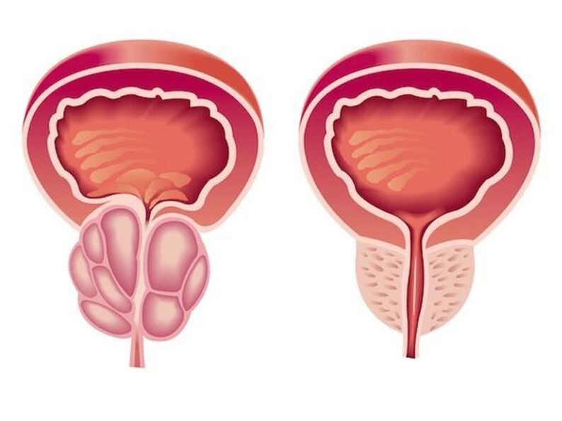 Ano ang hitsura ng prostatitis